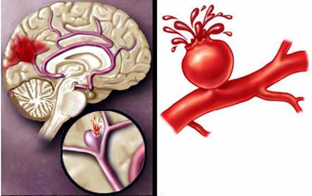 Ngộ độc rượu có thể dẫn đến tổn thương não không hồi phục