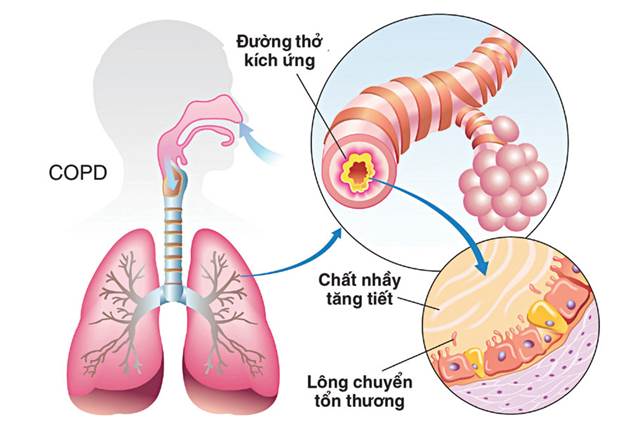 bệnh phổi tắc nghẽn mãn tính