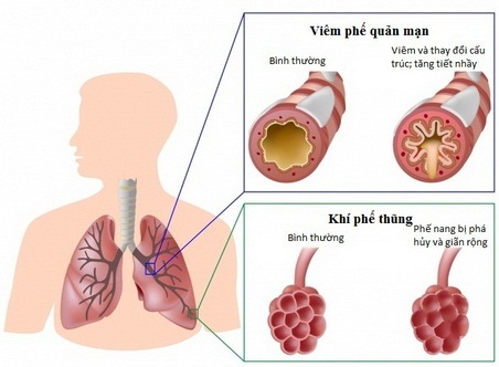 Bệnh phổi tắc nghẽn mạn tính.