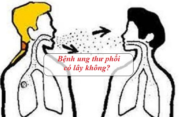 Ung thư phổi có lây không? Nguyên nhân, cách điều trị ung thư phổi hiệu quả