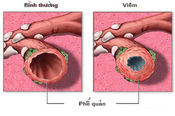 Phế quản bình thường và phế quản bị viêm