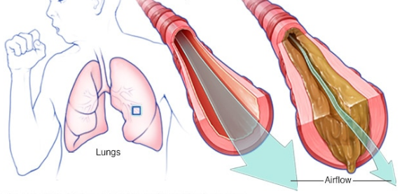 Ho, khó thở là triệu chứng điển hình của giãn phế quản