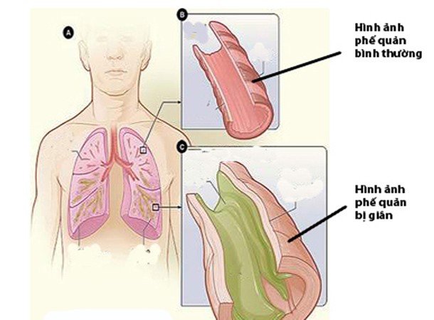 Phế quản bình thường và phế quản của người bệnh