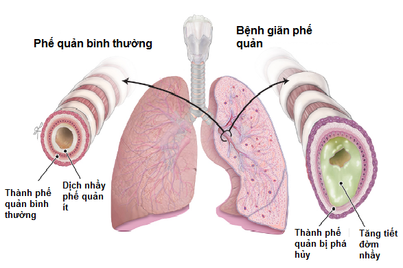 Thành phế quản bị phá hủy, phế quản giãn rộng và đờm nhầy được tăng tiết