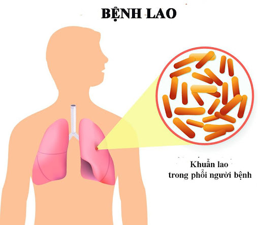 Bệnh lao phổi do trực khuẩn lao (Mycobacterium tuberculosis) gây ra