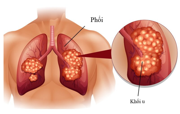 Nhiễm độc phổi có thể gây ra bệnh ung thư phổi