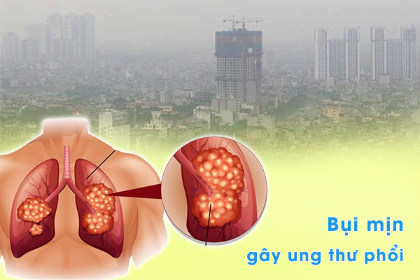 Bụi mịn gây ung thư phổi