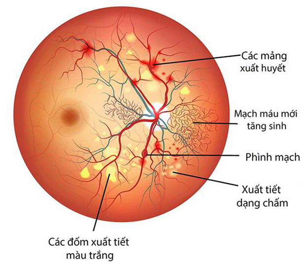 Bệnh võng mạc tiểu đường là gì? Nguyên nhân, triệu chứng và cách khắc phục