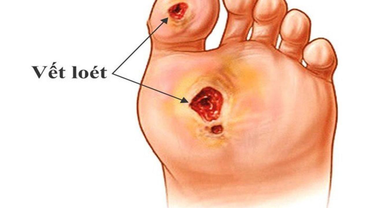 Vết thương ở người bệnh tiểu đường có thể lan rộng và hoại tử