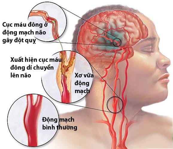 Tai biến mạch máu não là tình trạng rất nguy hiểm