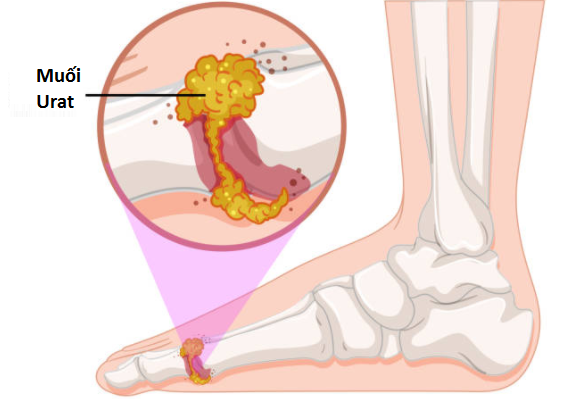 Bệnh gút là gì?