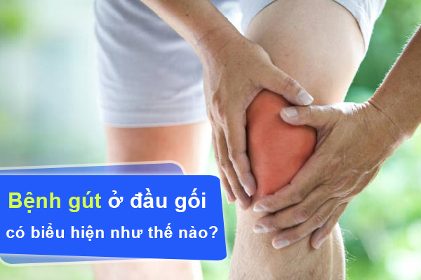 Bệnh gút ở đầu gối có biểu hiện như thế nào?