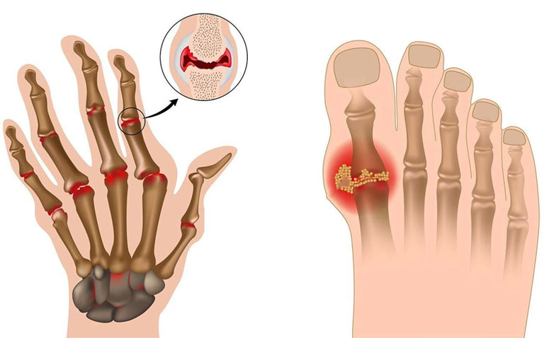 Có phải người bệnh gút cần kiêng đi đám tang không?