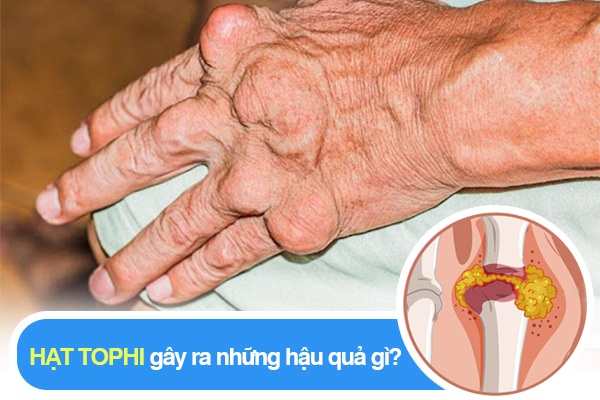 Hạt tophi gây ra những hậu quả gì?