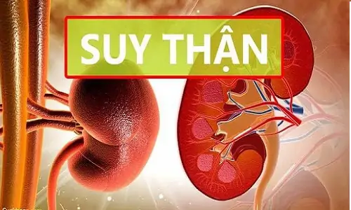 Bệnh nhân gút sẽ gặp phải biến chứng suy thận