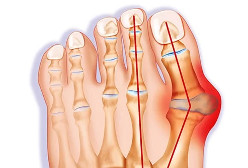 Biến dạng ngón chân cái (bunion)