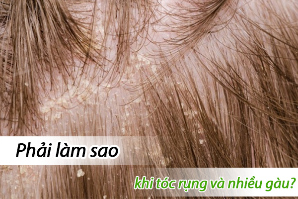 Phải làm sao khi tóc rụng và nhiều gàu?