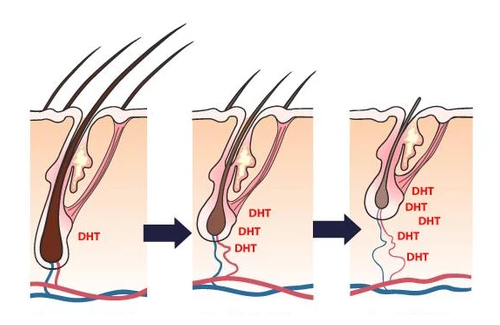 DHT sẽ khiến nang tóc bị teo nhỏ, tóc yêu và rụng dần