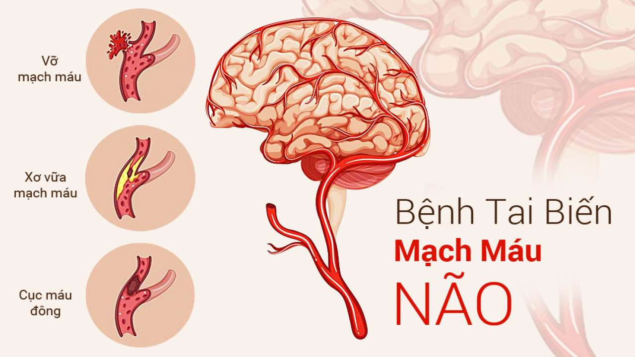 Mất ngủ ở người cao huyết áp kéo dài có thể dẫn đến tai biến mạch máu não