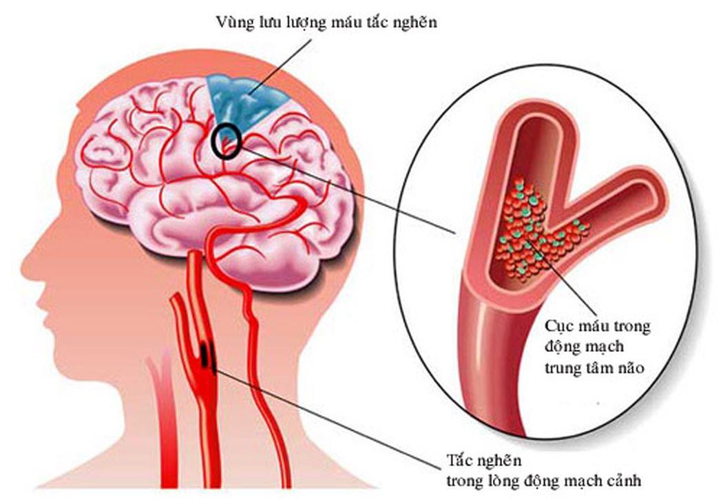 Nguyên nhân gây đột quỵ là sự bất ổn của tuần hoàn máu não