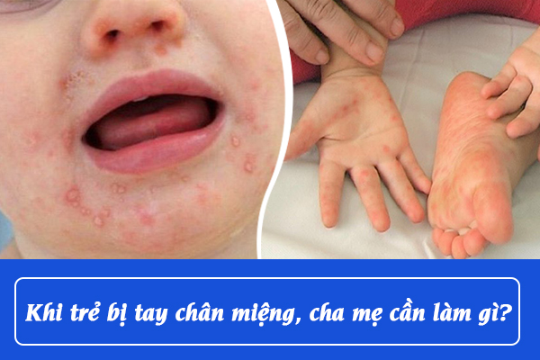 Khi trẻ bị tay chân miệng, cha mẹ cần làm gì?