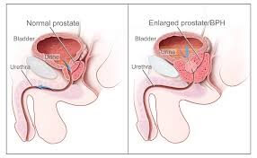 Bệnh phì đại tiền liệt tuyến là bệnh của đàn ông trung niên