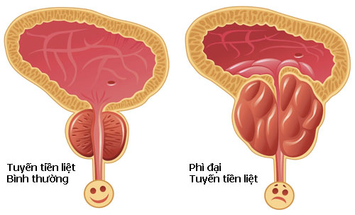 Nguyên nhân phì đại tiền liệt tuyến là gì?