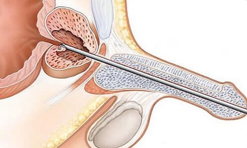 Phẫu thuật tiền liệt tuyến có rất nhiều rủi ro