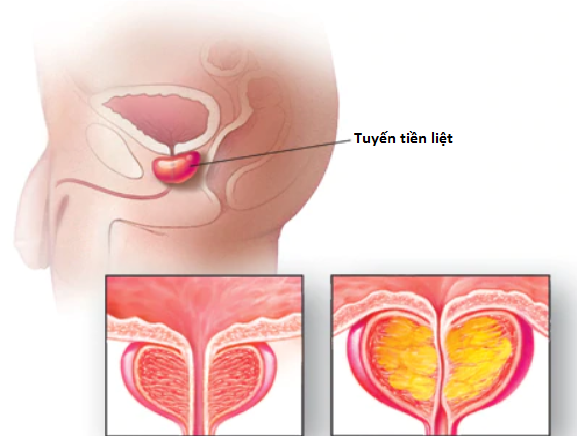 Tuyến tiền liệt nằm ở đâu và phì đại tiền liệt tuyến là gì?