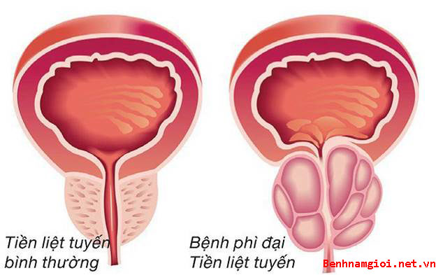 Kích thước bình thường của tuyến tiền liệt