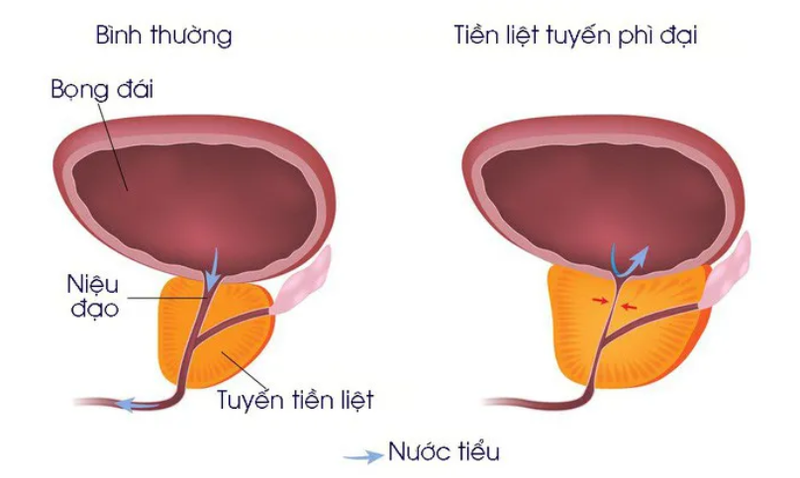 Chứng tiểu đêm do phì đại tuyến tiền liệt