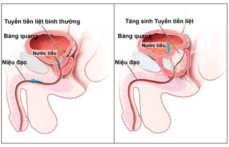 50% nam giới ở độ tuổi từ 60-70 tuổi bị u xơ tuyến tiền liệt