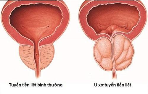 U xơ tuyến tiền liệt có mấy giai đoạn?