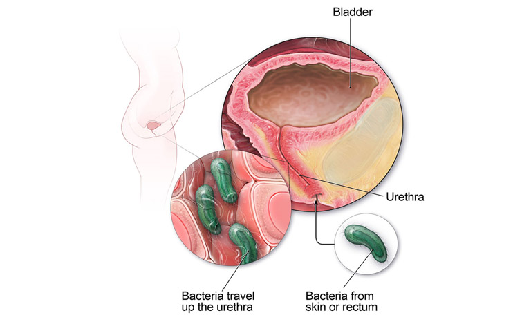 Tiểu rắt có thể là do bệnh viêm đường tiết niệu gây ra