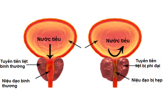 Phì đại tuyến tiền liệt là nguyên nhân hàng đầu gây tiểu khó ở nam giới