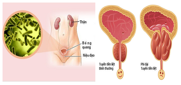 Viêm đường tiết niệu ở nữ giới và phì đại tuyến tiền liệt ở nam giới là 2 bệnh phổ biến gây ra tiểu rắt