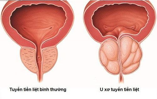 Bệnh u xơ tuyến tiền liệt rất thường gặp