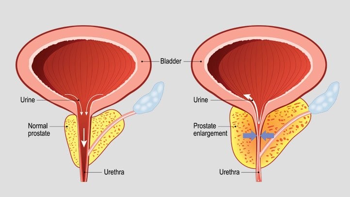 Phì đại tiền liệt tuyến có nguy hiểm không? Nguyên nhân và giải pháp tốt nhất (2020)