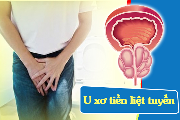 Bệnh lý u xơ tiền liệt tuyến