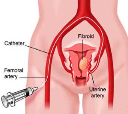 Phương pháp nút mạch điều trị u xơ tuyến tiền liệt