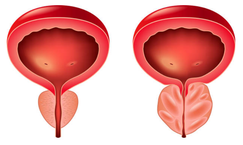 Nguyên nhân phì đại tuyến tiền liệt là gì?