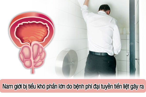 Nam giới bị tiểu khó phần lớn do bệnh phì đại tuyến tiền liệt gây ra