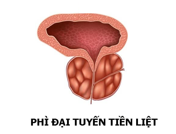 Phải làm sao để khắc phục phì đại tuyến tiền liệt?