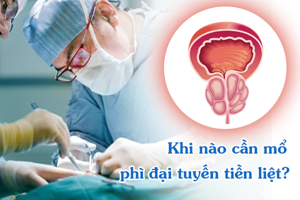 Khi nào cần mổ phì đại tuyến tiền liệt?