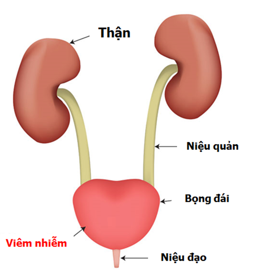 Biến chứng viêm đường tiết niệu do phì đại tuyến tiền liệt nguy hiểm như thế nào?