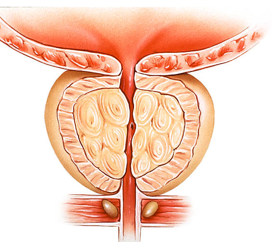  Cách phòng ngừa biến chứng phì đại tuyến tiền liệt là gì?