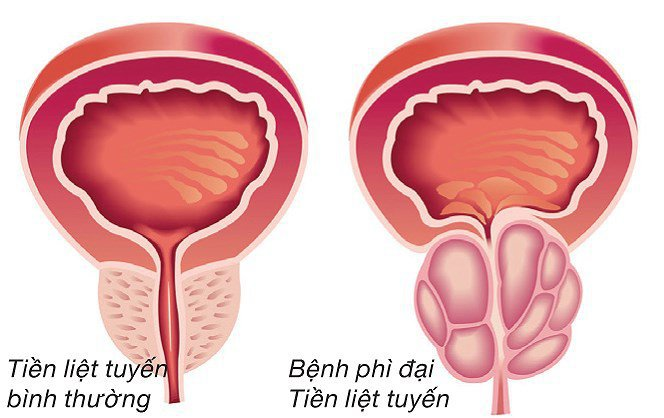 Bệnh phì đại tuyến tiền liệt