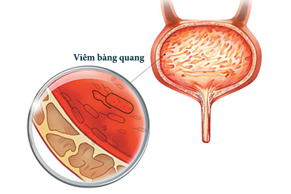 Bệnh viêm bàng quang