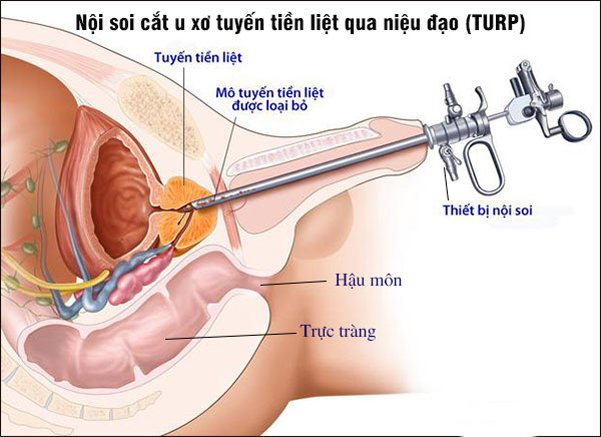 Nội soi cắt u xơ tuyến tiền liệt qua niệu đạo