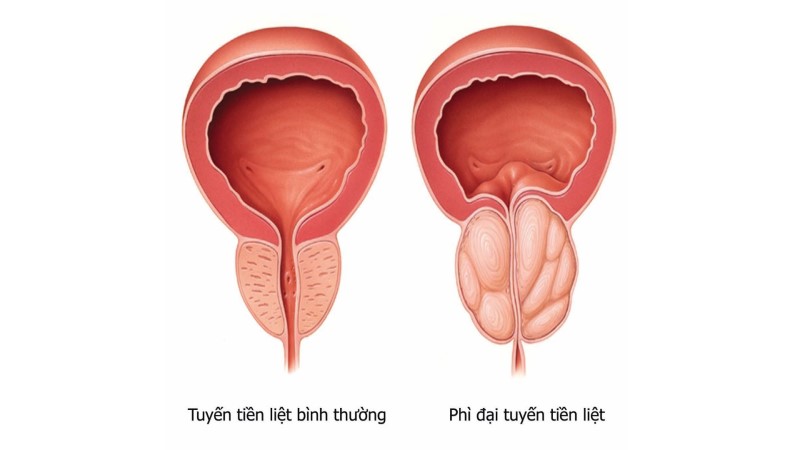 Những biện pháp nào giúp giảm kích thước phì đại tiền liệt tuyến?